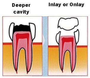 deeper cavity